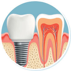 dental implant diagram