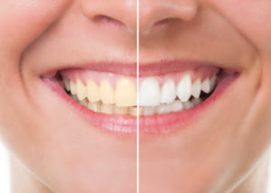Photo of a smiling woman with the left half of the smile yellowed and the right half white after professional dental whitening