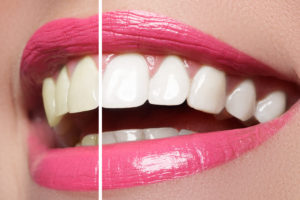 Close up of a smile before and after teeth whitening