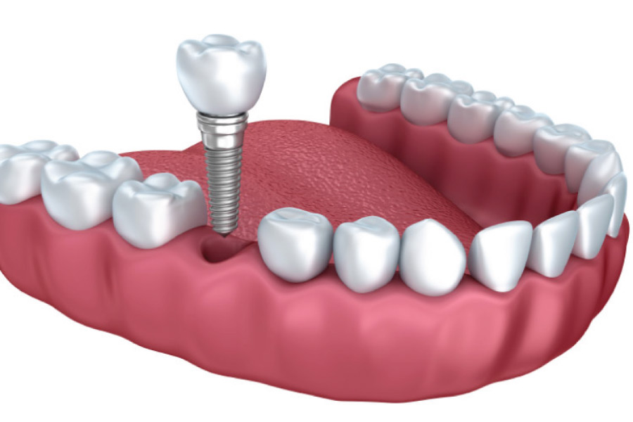 dental implant model