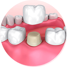 dental crowns and bridges diagram