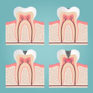 signs of tooth decay