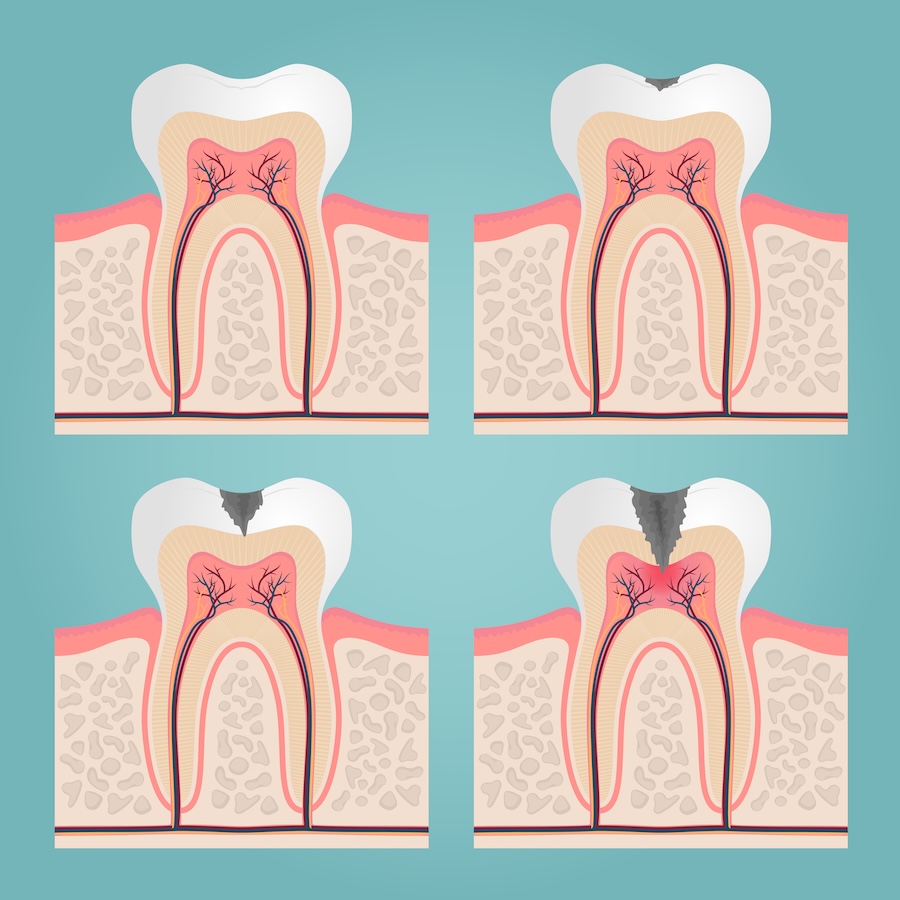 signs of tooth decay