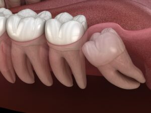 wisdom tooth growing in