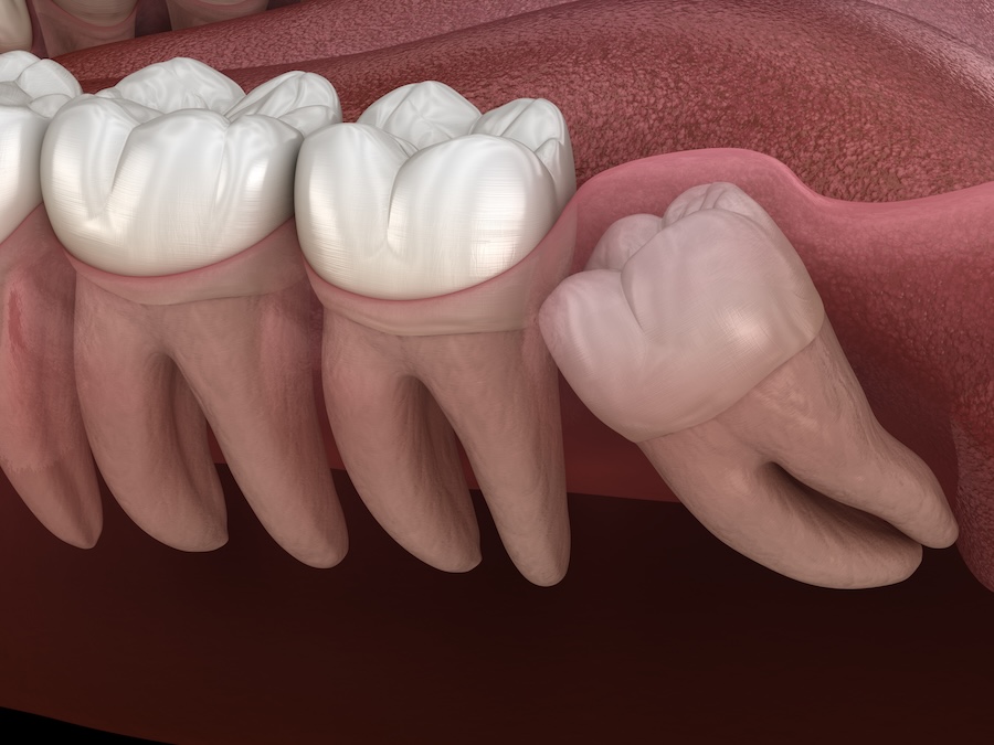 wisdom tooth growing in